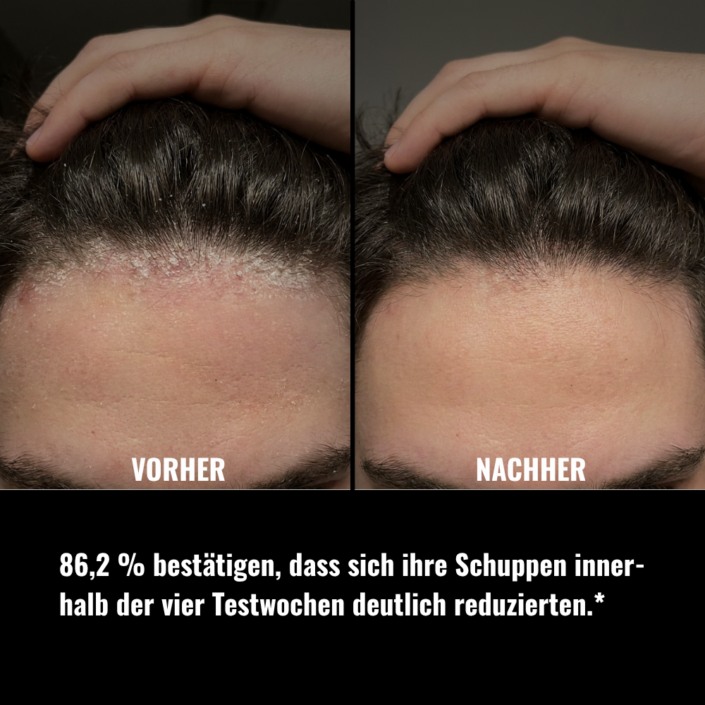 Festes Shampoo Anti-Schuppen - 100g